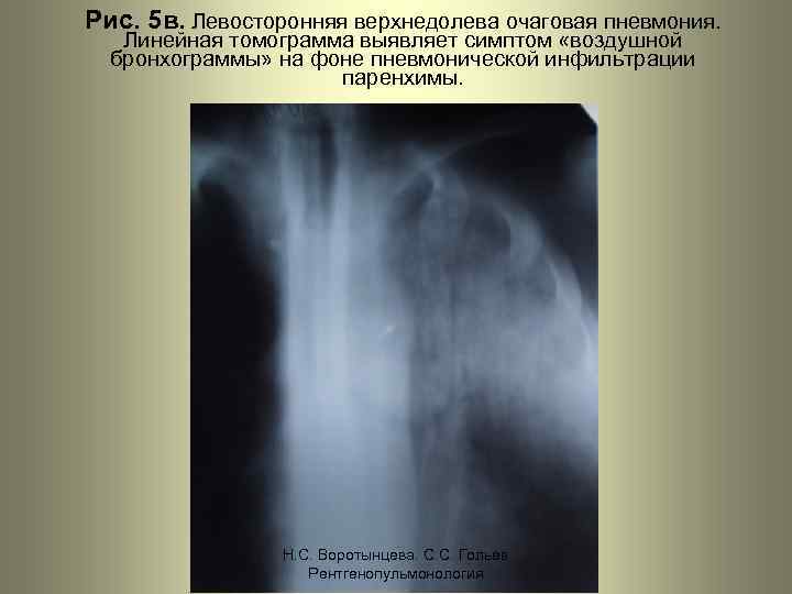 Рис. 5 в. Левосторонняя верхнедолева очаговая пневмония. Линейная томограмма выявляет симптом «воздушной бронхограммы» на