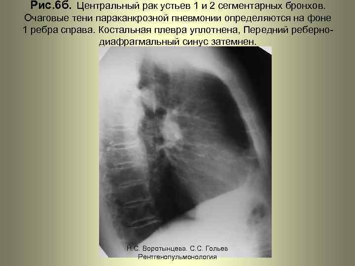 Рис. 6 б. Центральный рак устьев 1 и 2 сегментарных бронхов. Очаговые тени параканкрозной