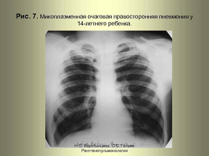 Рис. 7. Микоплазменная очаговая правосторонняя пневмония у 14 -летнего ребенка. Н. С. Воротынцева. С.