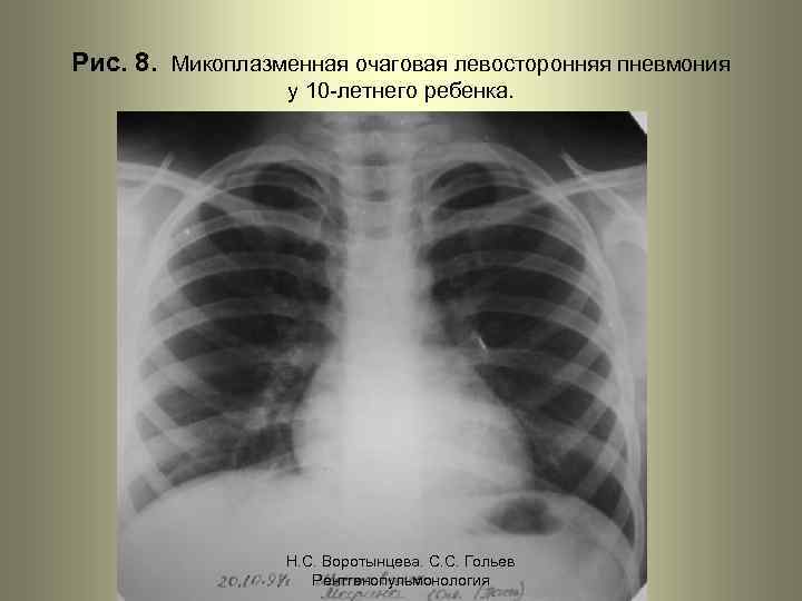 Рис. 8. Микоплазменная очаговая левосторонняя пневмония у 10 -летнего ребенка. Н. С. Воротынцева. С.