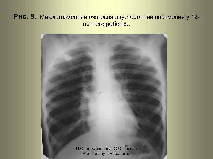 Рис. 9. Микоплазменная очаговая двусторонняя пневмония у 12 летнего ребенка. Н. С. Воротынцева. С.