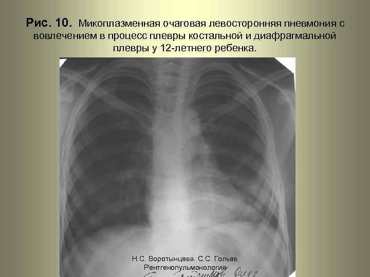 Рис. 10. Микоплазменная очаговая левосторонняя пневмония с вовлечением в процесс плевры костальной и диафрагмальной