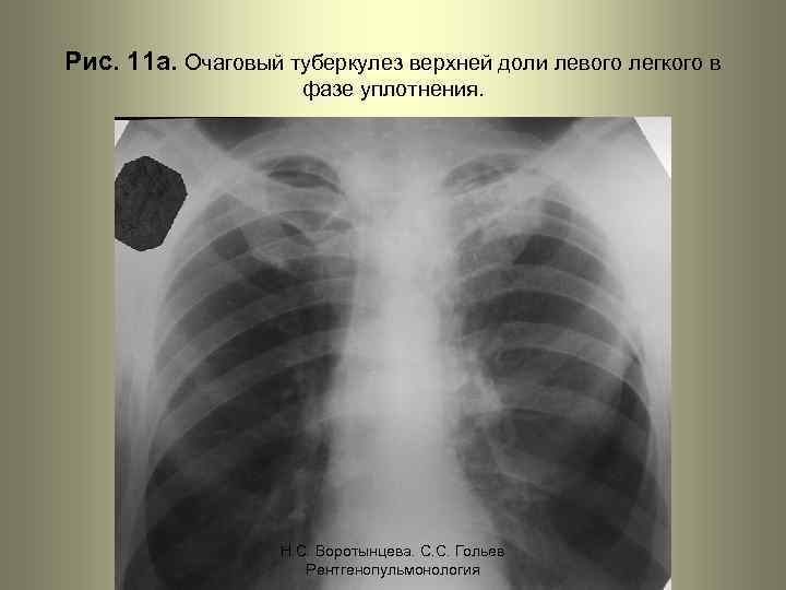 Рис. 11 а. Очаговый туберкулез верхней доли левого легкого в фазе уплотнения. Н. С.