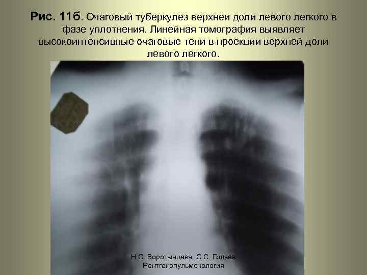 Рис. 11 б. Очаговый туберкулез верхней доли левого легкого в фазе уплотнения. Линейная томография