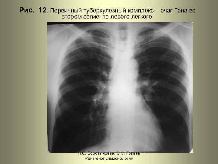 Рис. 12. Первичный туберкулезный комплекс – очаг Гона во втором сегменте левого легкого. Н.