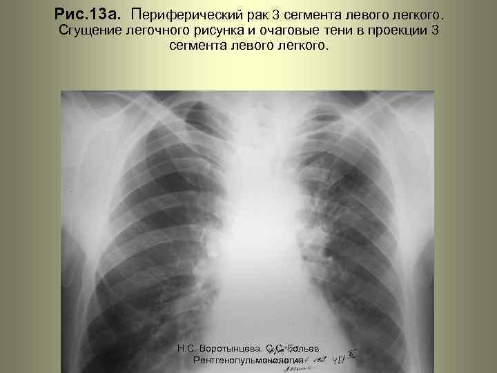 Рис. 13 а. Периферический рак 3 сегмента левого легкого. Сгущение легочного рисунка и очаговые