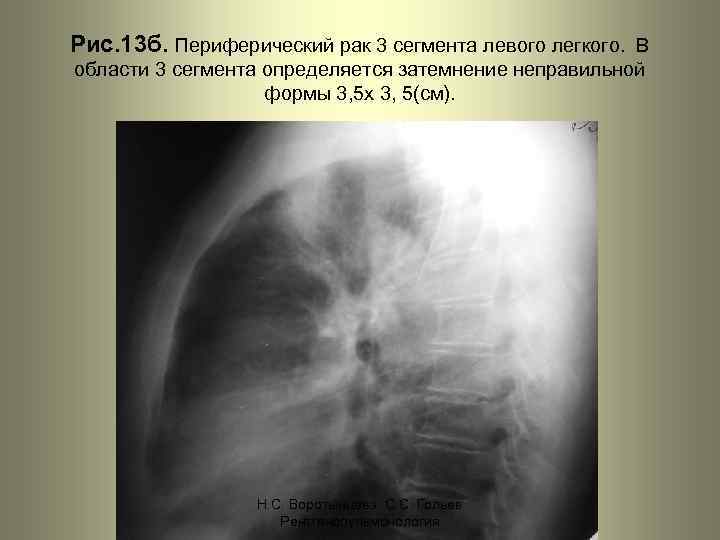 Рис. 13 б. Периферический рак 3 сегмента левого легкого. В области 3 сегмента определяется