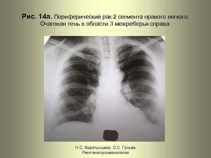 Рис. 14 а. Периферический рак 2 сегмента правого легкого. Очаговая тень в области 3