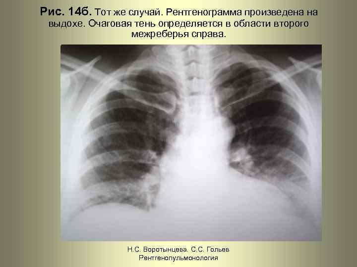 Рис. 14 б. Тот же случай. Рентгенограмма произведена на выдохе. Очаговая тень определяется в