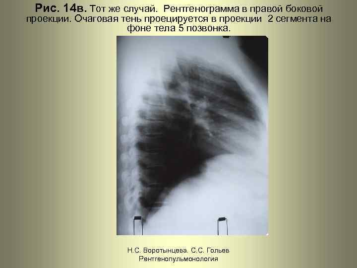 Рис. 14 в. Тот же случай. Рентгенограмма в правой боковой проекции. Очаговая тень проецируется