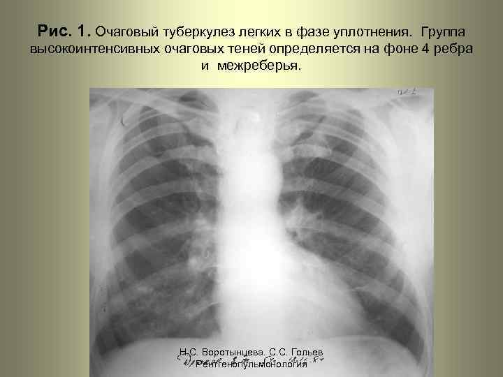 Рис. 1. Очаговый туберкулез легких в фазе уплотнения. Группа высокоинтенсивных очаговых теней определяется на