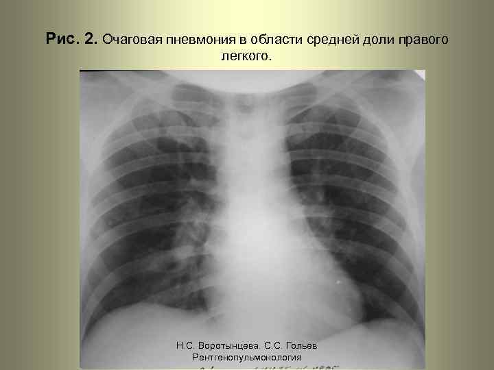 Рис. 2. Очаговая пневмония в области средней доли правого легкого. Н. С. Воротынцева. С.