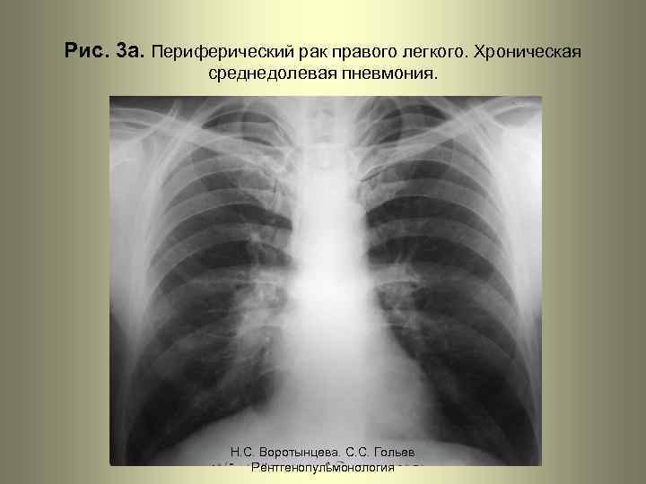 Рис. 3 а. Периферический рак правого легкого. Хроническая среднедолевая пневмония. Н. С. Воротынцева. С.