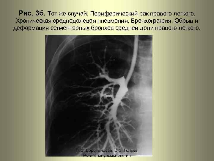 Рис. 3 б. Тот же случай. Периферический рак правого легкого. Хроническая среднедолевая пневмония. Бронхография.