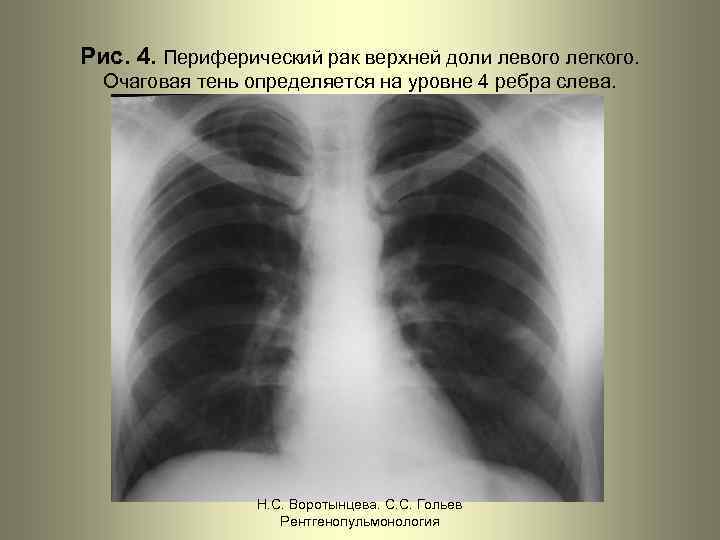 Рис. 4. Периферический рак верхней доли левого легкого. Очаговая тень определяется на уровне 4