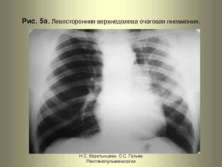 Рис. 5 а. Левосторонняя верхнедолева очаговая пневмония. Н. С. Воротынцева. С. С. Гольев Рентгенопульмонология