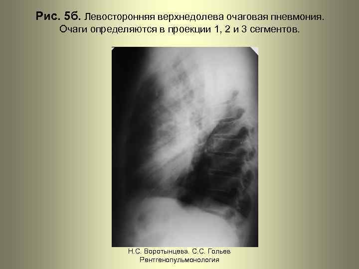 Рис. 5 б. Левосторонняя верхнедолева очаговая пневмония. Очаги определяются в проекции 1, 2 и