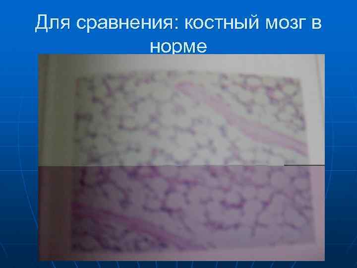 Для сравнения: костный мозг в норме 