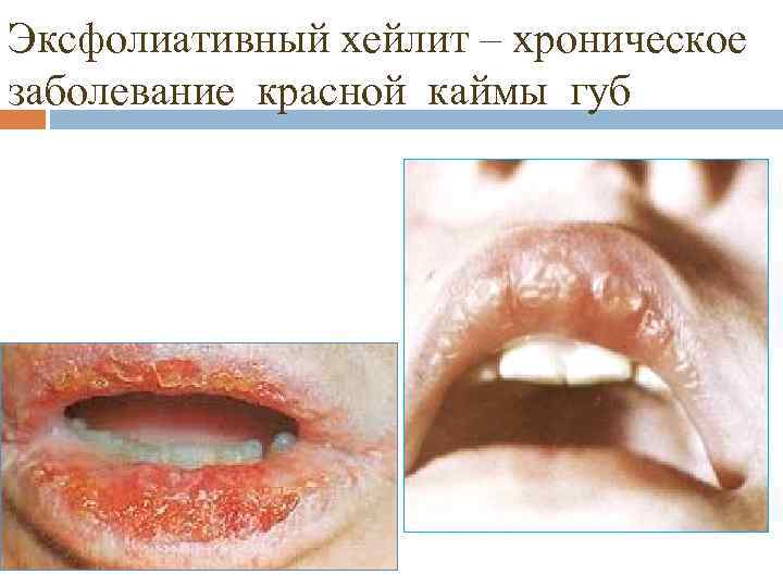 Эксфолиативный хейлит – хроническое заболевание красной каймы губ 