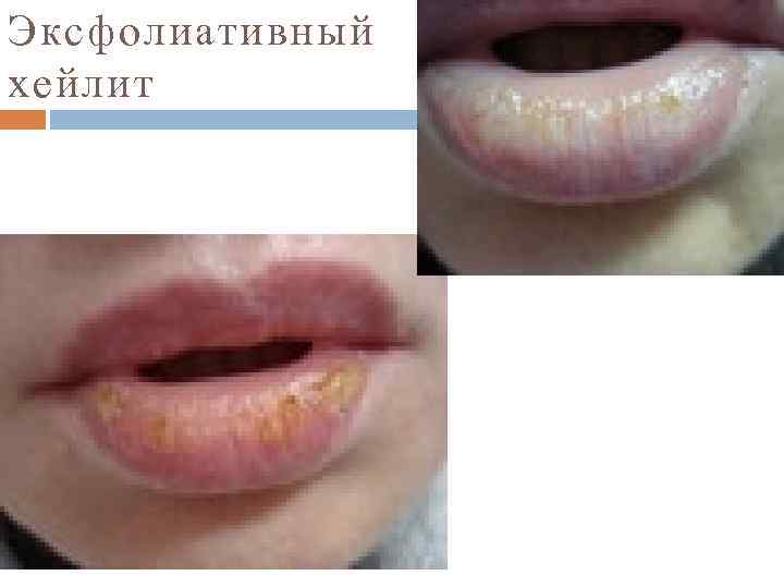 Эксфолиативный хейлит 