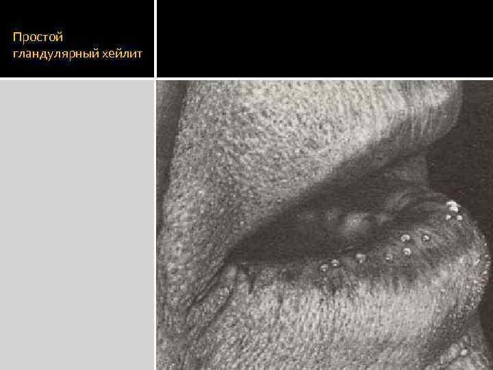 Простой гландулярный хейлит 