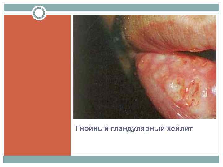 Гнойный гландулярный хейлит 