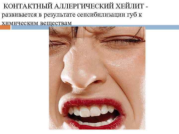 КОНТАКТНЫЙ АЛЛЕРГИЧЕСКИЙ ХЕЙЛИТ развивается в результате сенсибилизации губ к химическим веществам 