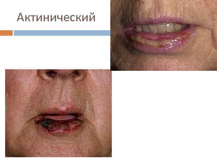 Актинический 