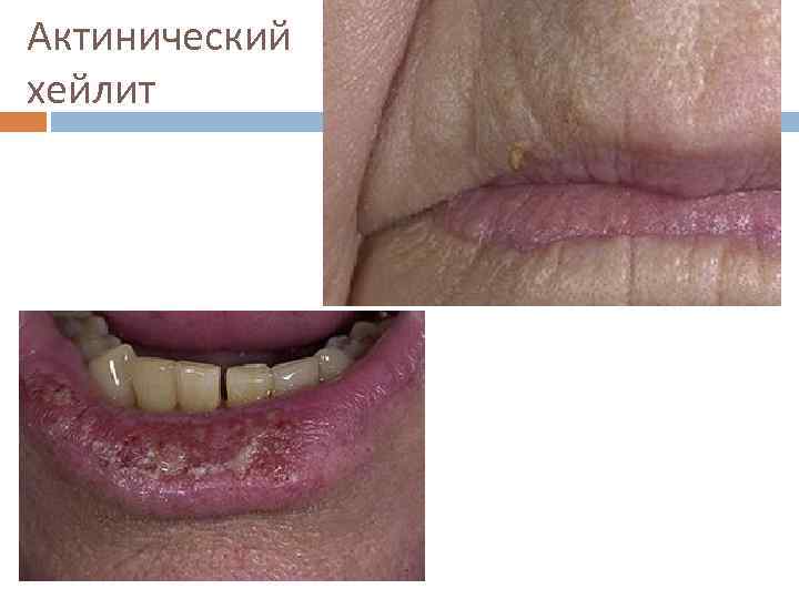 Актинический хейлит 