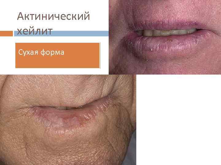 Актинический хейлит Сухая форма 