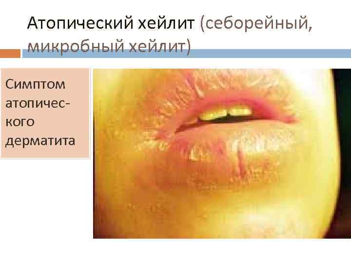 Атопический хейлит (себорейный, микробный хейлит) Симптом атопического дерматита 