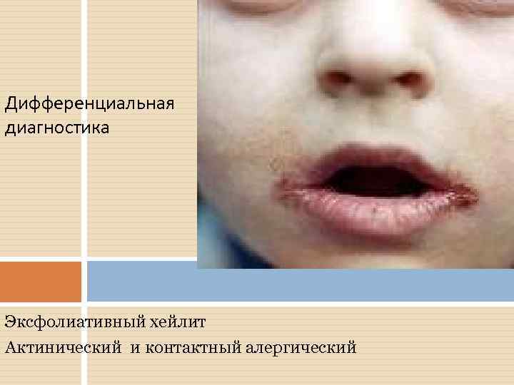 Дифференциальная диагностика Эксфолиативный хейлит Актинический и контактный алергический 