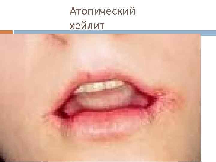 Атопический хейлит 