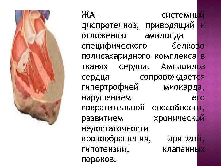 ЖА – системный диспротеиноз, приводящий к отложению амилоида – специфического белковополисахаридного комплекса в тканях