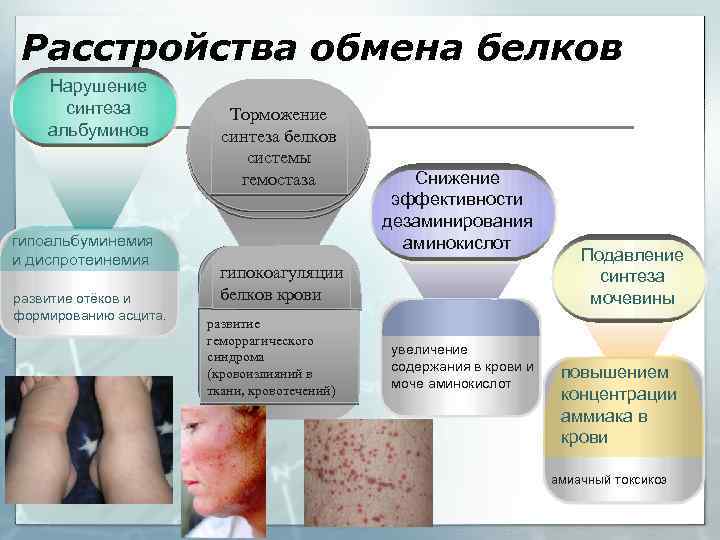 Расстройства обмена белков Нарушение синтеза альбуминов гипоальбуминемия и диспротеинемия развитие отёков и формированию асцита.