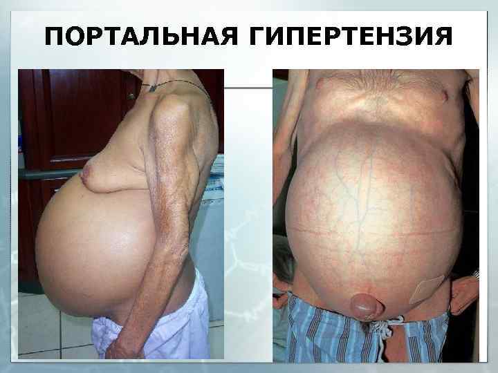 ПОРТАЛЬНАЯ ГИПЕРТЕНЗИЯ 
