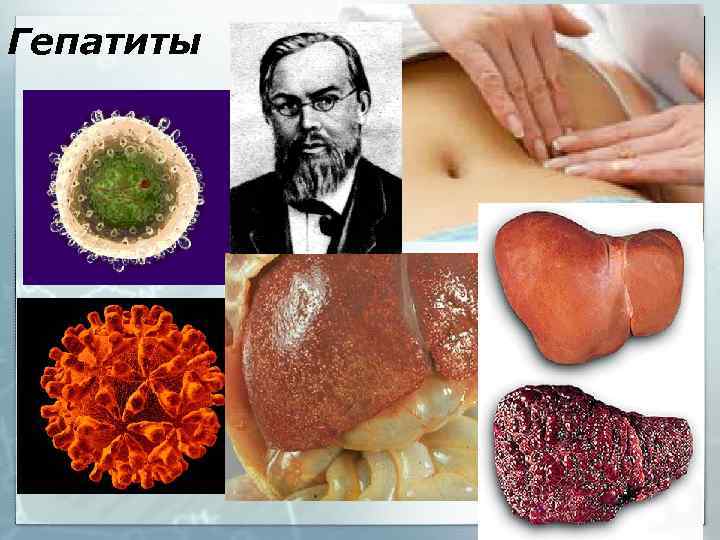 Гепатиты 