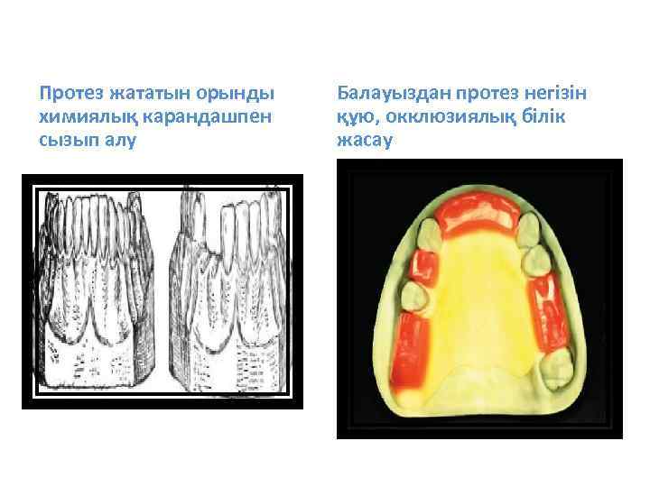 Протез жататын орынды химиялық карандашпен сызып алу Балауыздан протез негізін құю, окклюзиялық білік жасау