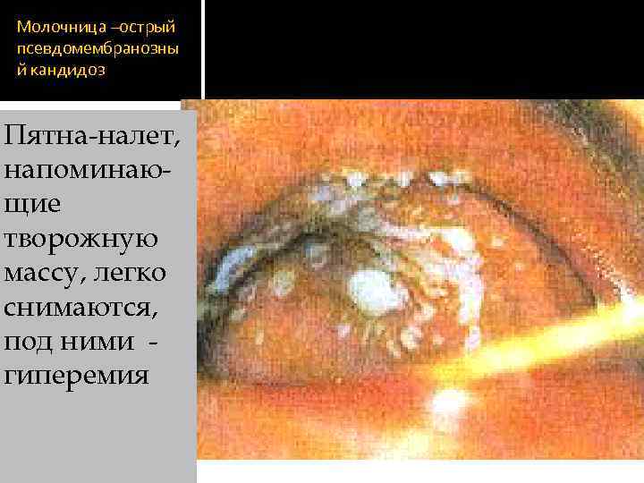 Молочница –острый псевдомембранозны й кандидоз Пятна-налет, напоминающие творожную массу, легко снимаются, под ними гиперемия