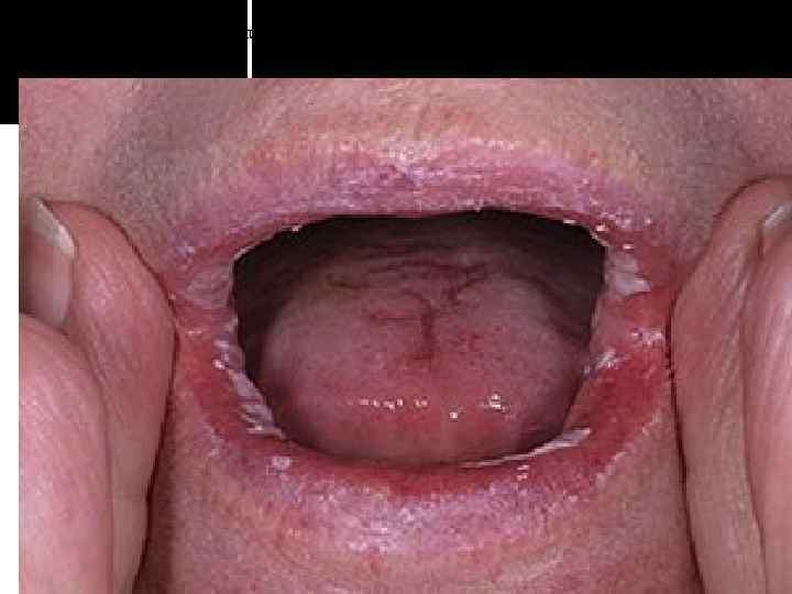 Острый атрофический кандидоз 