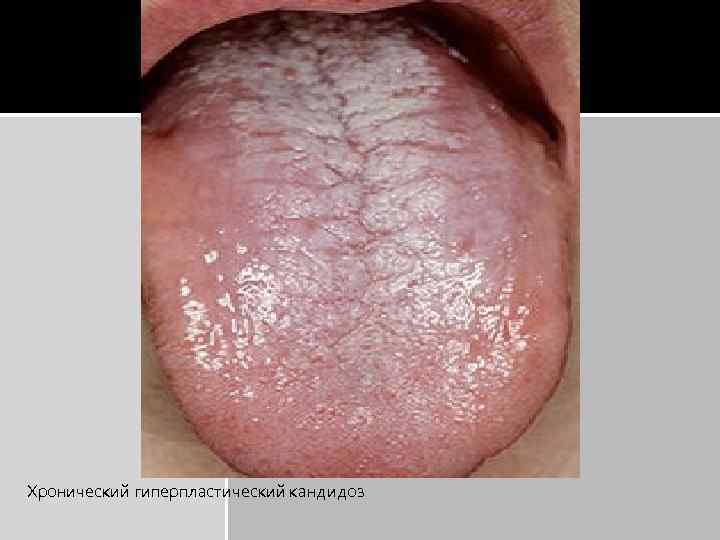Хронический гиперпластический кандидоз 