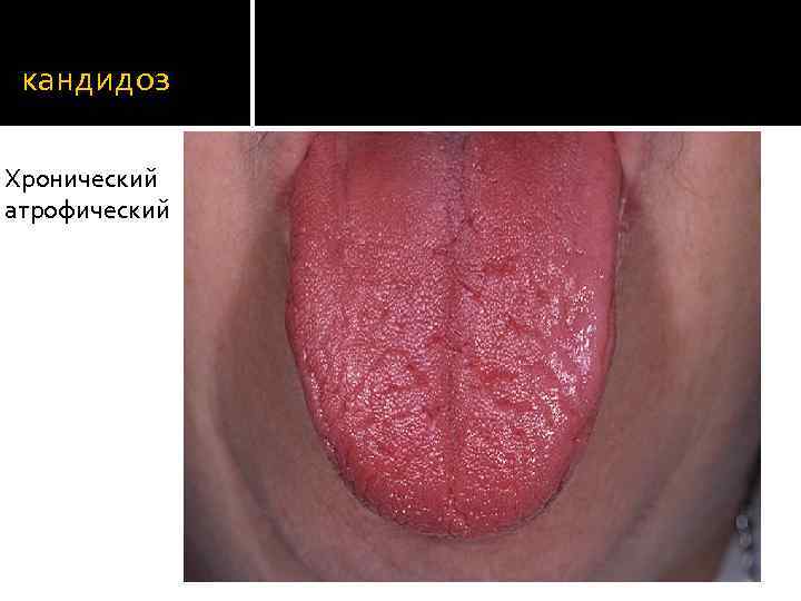кандидоз Хронический атрофический 