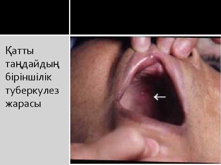 Қатты таңдайдың біріншілік туберкулез жарасы 
