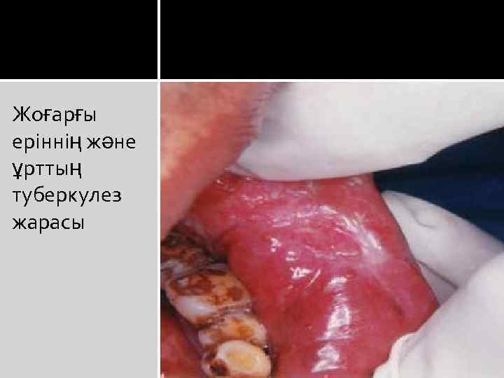 Жоғарғы еріннің және ұрттың туберкулез жарасы 