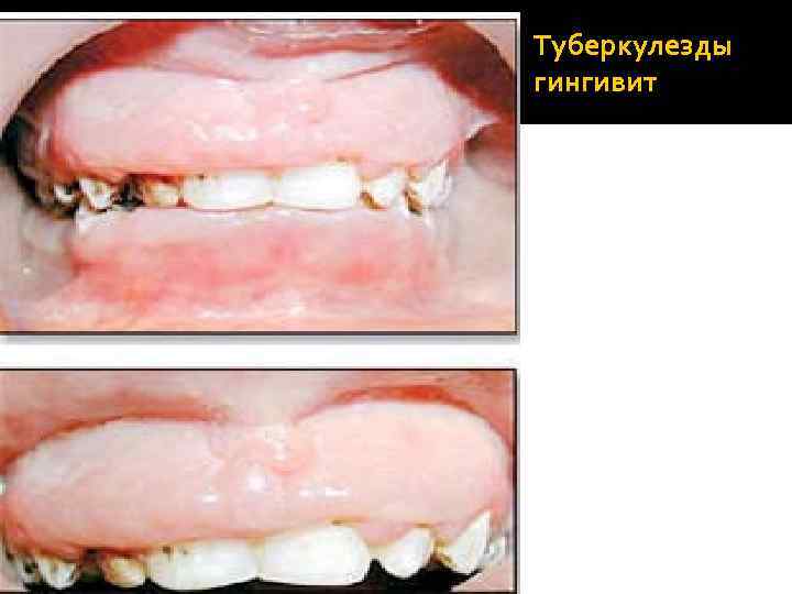 Туберкулезды гингивит 
