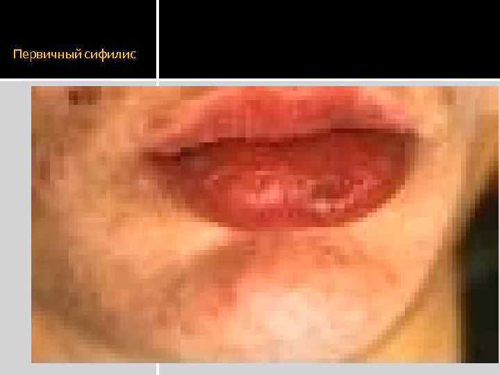 Первичный сифилис 