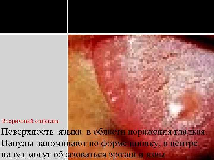 Вторичный сифилис Поверхность языка в области поражения гладкая. Папулы напоминают по форме шишку, в