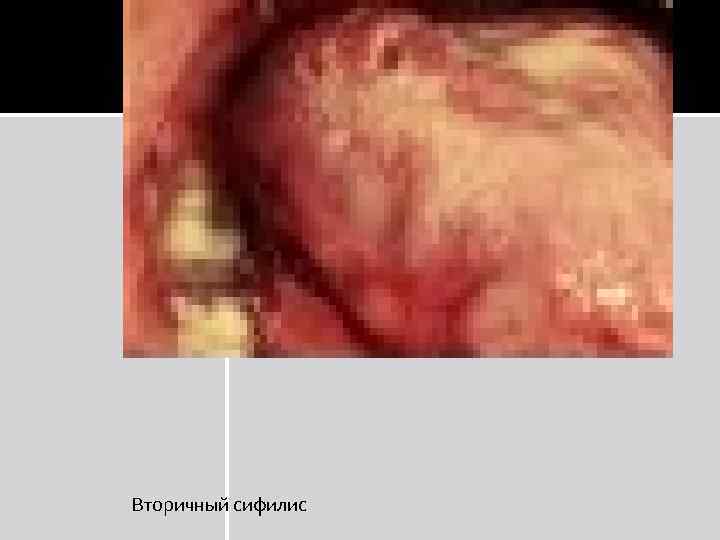 Вторичный сифилис 