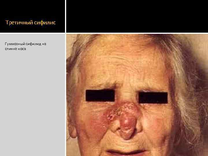 Третичный сифилис Гуммозный сифилид на спинке носа 