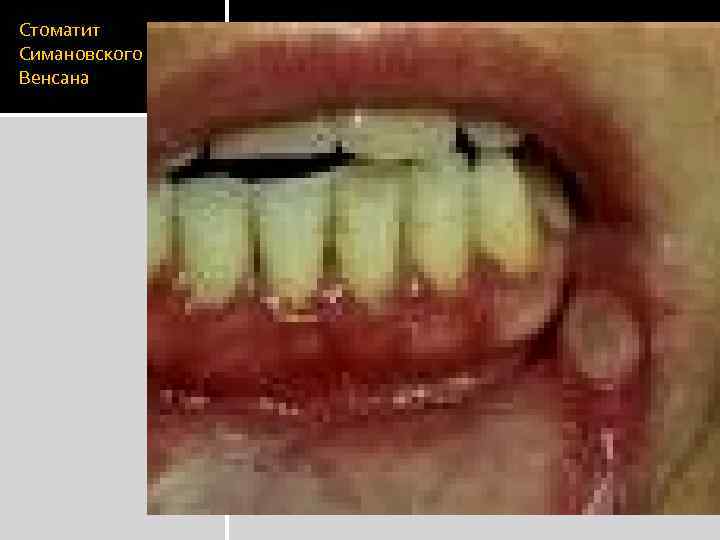 Стоматит Симановского Венсана 